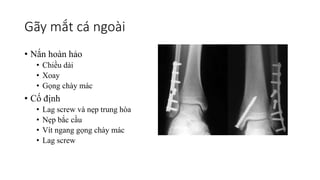 Gãy mắt cá ngoài
• Nắn hoàn hảo
• Chiều dài
• Xoay
• Gọng chày mác
• Cố định
• Lag screw và nẹp trung hòa
• Nẹp bắc cầu
• Vít ngang gọng chày mác
• Lag screw
 