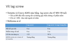 Vít lag screw
• Tornetta và Creevy KHX mác bằng lag screw cho 47 BN<50 tuổi
• Tất cả BN đều liễn xương tốt và không gây biến chừng về phần mềm
• Chỉ có 1 BN: đau mặt ngoài cổ chân
• McKenna at el
Lag screw Lag screw và nẹp trung hòa
Mất kết quả nắn 0 ca 0 ca
Nhiễm trùng vết mổ 0 ca 3 ca
Lồi lên của dụng cụ 125 50 %
AOFAS scores at a mean of
12 months
Tương đồng Tương đồng
 