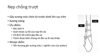 Nẹp chống trượt
• Gãy xương mác chéo từ trước dưới lên sau trên
• Xương loãng
• Ưu điểm:
• Bóc tách ít
• Giảm được sự lồi của nẹp lên da
• Cố định tốt mãnh gãy đầu xa
• Tránh được biến chứng vít đầu xa đi vào khớp
• Nhược điểm
• Tổn thương gân xương mác ( nghiên cứu của weber)
 