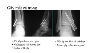 Gãy mắt cá trong
• Vít xốp 4.0mm ren ngắn
• Vuông góc với đường gãy
• Ép hai mặt gãy
• Néo ép với kim và chỉ thép
• Mãnh gãy mắt cá trong nhỏ
 