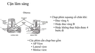 Cận lâm sàng
Ottawa
• Các phim cần chụp bao gồm
• AP View
• Lateral view
• Motise view
• Chụp phim xquang cổ chân khi:
• Đau vùng A
• Hoặc đau vùng B
• Hoặc không thực hiện được 4
bước đi
 