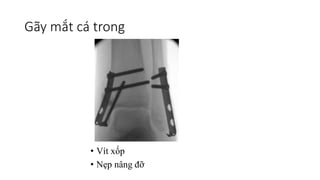Gãy mắt cá trong
• Vít xốp
• Nẹp nâng đỡ
 