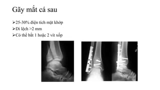 Gãy mắt cá sau
25-30% điện tích mặt khớp
Di lệch >2 mm
Có thể bắt 1 hoặc 2 vít xốp
 