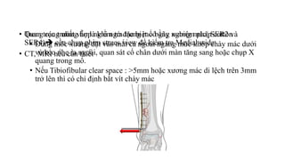 • Trong các trường hợp nghi ngờ đặc biệt có gãy xương mác( SER2 và
SER4) cần chụp phim strees view để kiểm tra Medial wide
• CT, MRI nếu cần thiết
• Quan trọng nhất vẫn là kiểm tra trong mổ bằng nghiệm pháp cotton
• Dùng móc xương đặt vào mắt cá ngoài ngang mức khớp chày mác dưới
và kéo nhẹ ra ngoài, quan sát cổ chân dưới màn tăng sang hoặc chụp X
quang trong mổ.
• Nếu Tibiofibular clear space : >5mm hoặc xương mác di lệch trên 3mm
trở lên thì có chỉ định bắt vít chày mác
 