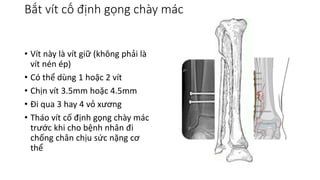 Bắt vít cố định gọng chày mác
• Vít này là vít giữ (không phải là
vít nén ép)
• Có thể dùng 1 hoặc 2 vít
• Chịn vít 3.5mm hoặc 4.5mm
• Đi qua 3 hay 4 vỏ xương
• Tháo vít cố định gọng chày mác
trước khi cho bệnh nhân đi
chống chân chịu sức nặng cơ
thể
 