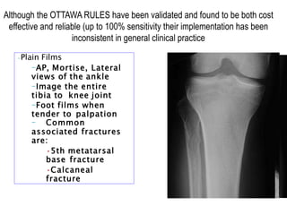 •Plain Films
–AP, Mortise, Lateral
views of the ankle
–Image the entire
tibia to knee joint
–Foot films when
tender to palpation
– Common
associated fractures
are:
•5th metatarsal
base fracture
•Calcaneal
fracture
Although the OTTAWA RULES have been validated and found to be both cost
effective and reliable (up to 100% sensitivity their implementation has been
inconsistent in general clinical practice
 
