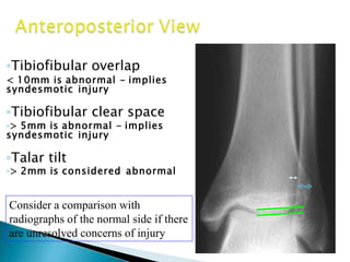 Quaitative analysis◦Tibiofibular overlap
< 10mm is abnormal - implies
syndesmotic injury
◦Tibiofibular clear space
◦> 5mm is abnormal - implies
syndesmotic injury
◦Talar tilt
◦> 2mm is considered abnormal
Consider a comparison with
radiographs of the normal side if there
are unresolved concerns of injury
 