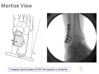 10 degrees internal rotation of 5th MT with respect to a verticalline
 