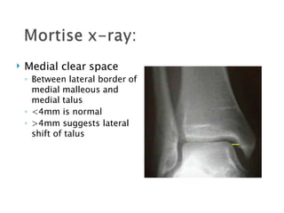  Medial clear space
◦ Between lateral border of
medial malleous and
medial talus
◦ <4mm is normal
◦ >4mm suggests lateral
shift of talus
 