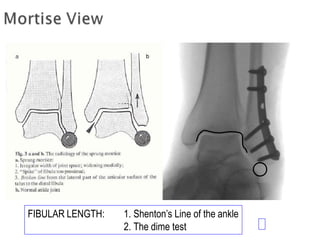 FIBULAR LENGTH: 1. Shenton’s Line of the ankle
2. The dime test
 