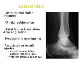 •Posterior mallelolar
fractures
•AP talar subluxation
•Distal fibular translation
&/or angulation
•Syndesmotic relationship
•Associated or occult
injuries
–Lateral process talus
–Posterior process talus
–Anterior process calcaneus
 