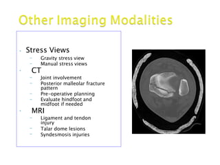 • Stress Views
– Gravity stress view
– Manual stress views
• CT
Joint involvement
Posterior malleolar fracture
pattern
Pre-operative planning
–
–
–
– Evaluate hindfoot and
midfoot if needed
• MRI
Ligament and tendon–
–
–
injury
Talar dome lesions
Syndesmosis injuries
 