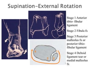 1
3 2
4
Stage 1 Anterior
tibio- fibular
ligament
Stage 2 Fibula fx
Stage 3 Posterior
malleolus fx or
posterior tibio-
fibular ligament
Stage 4 Deltoid
ligament tear or
medial malleolus
fx
 