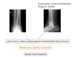 Standard: Closed management
Lateral Injury: classic posterosuperioranteroinferior fibula fracture
Medial Injury: Stability maintained
 