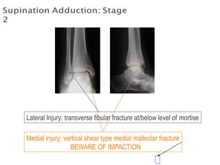 Lateral Injury: transverse fibular fracture at/below level of mortise
Medial injury: vertical shear type medial malleolar fracture
BEWARE OF IMPACTION
 