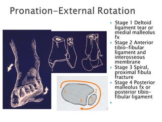  Stage 1 Deltoid
ligament tear or
medial malleolus
fx
 Stage 2 Anterior
tibio-fibular
ligament and
interosseous
membrane
 Stage 3 Spiral,
proximal fibula
fracture
 Stage 4 Posterior
malleolus fx or
posterior tibio-
fibular ligament

34
1 2
 