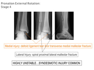 Medial injury: deltoid ligament tear &/or transverse medial malleolar fracture
Lateral Injury: spiral proximal lateral malleolar fracture
HIGHLY UNSTABLE…SYNDESMOTIC INJURY COMMON
 