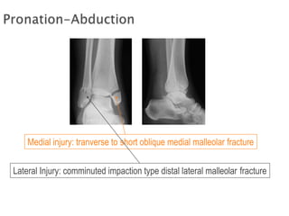 Medial injury: tranverse to short oblique medial malleolar fracture
Lateral Injury: comminuted impaction type distal lateral malleolar fracture
 