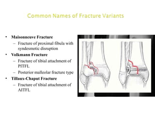 •
•
•
Maisonneuve Fracture
– Fracture of proximal fibula with
syndesmotic disruption
Volkmann Fracture
– Fracture of tibial attachment of
PITFL
– Posterior malleolar fracture type
Tillaux-Chaput Fracture
– Fracture of tibial attachment of
AITFL
 
