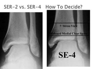  SER-2
 Negative Stress view
 External rotation of
foot with ankle in
neutral flexion (00)
+ Stress View
Widened Medial Clear Space
SE-4
 