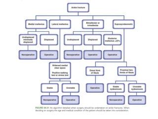 Simple algorithm for ankle fractures:
 