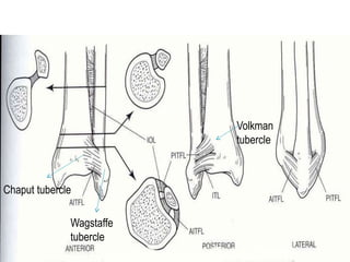 Chaput tubercle
Wagstaffe
tubercle
Volkman
tubercle
 