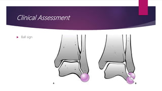 Ball Sign Radiology Ankle fracture | PPTX