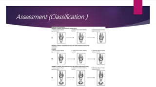 Ankle fracture | PPTX
