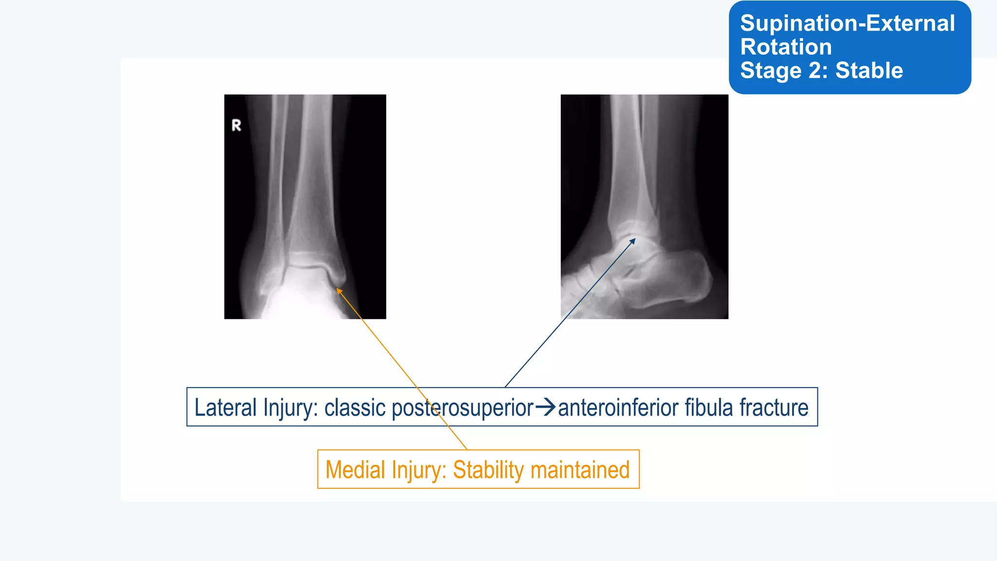 Ankle fracture | PPTX