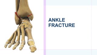 ANKLE
FRACTURE
 