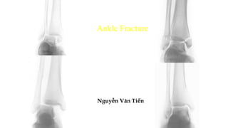 Ankle Fracture
Nguyễn Văn Tiến
 