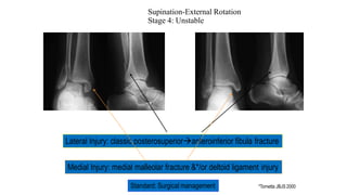 Supination-External Rotation
Stage 4: Unstable
Lateral Injury: classic posterosuperioranteroinferior fibula fracture
Medial Injury: medial malleolar fracture &*/or deltoid ligament injury
Standard: Surgical management *Tornetta JBJS 2000
 