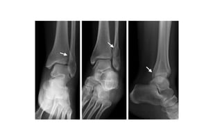ankle fracture-.pptx