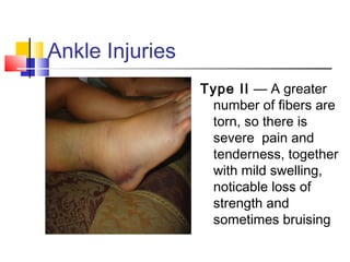 Ankle Injuries
                 Type II — A greater
                  number of fibers are
                  torn, so there is
                  severe pain and
                  tenderness, together
                  with mild swelling,
                  noticable loss of
                  strength and
                  sometimes bruising
 
