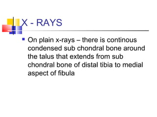 X - RAYS
   On plain x-rays – there is continous
    condensed sub chondral bone around
    the talus that extends from sub
    chondral bone of distal tibia to medial
    aspect of fibula
 
