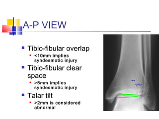 A-P VIEW

   Tibio-fibular overlap
       <10mm implies
        syndesmotic injury
   Tibio-fibular clear
    space
       >5mm implies
        syndesmotic injury
   Talar tilt
       >2mm is considered
        abnormal
 