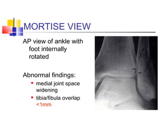 MORTISE VIEW
AP view of ankle with
 foot internally
 rotated

Abnormal findings:
     medial joint space
      widening
     tibia/fibula overlap
      <1mm
 