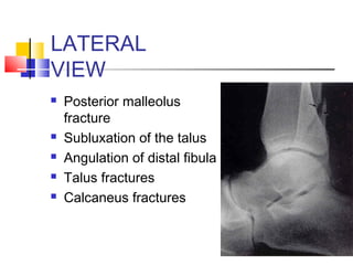 LATERAL
VIEW
   Posterior malleolus
    fracture
   Subluxation of the talus
   Angulation of distal fibula
   Talus fractures
   Calcaneus fractures
 