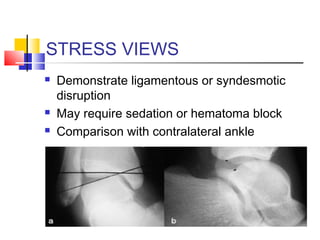 STRESS VIEWS
   Demonstrate ligamentous or syndesmotic
    disruption
   May require sedation or hematoma block
   Comparison with contralateral ankle
 
