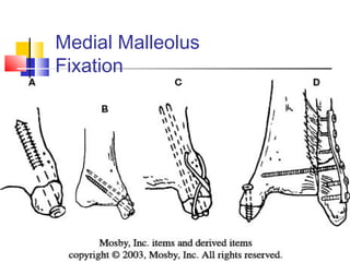 Medial Malleolus
Fixation
 