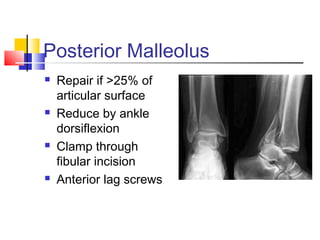 Posterior Malleolus
   Repair if >25% of
    articular surface
   Reduce by ankle
    dorsiflexion
   Clamp through
    fibular incision
   Anterior lag screws
 