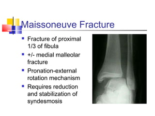 Maissoneuve Fracture
   Fracture of proximal
    1/3 of fibula
   +/- medial malleolar
    fracture
   Pronation-external
    rotation mechanism
   Requires reduction
    and stabilization of
    syndesmosis
 