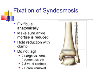 Fixation of Syndesmosis

   Fix fibula
    anatomically
   Make sure ankle
    mortise is reduced
   Hold reduction with
    clamp
   Do not lag!
       ? Large vs. small
        fragment screw
       ? 3 vs. 4 cortices
       ? Screw removal
 