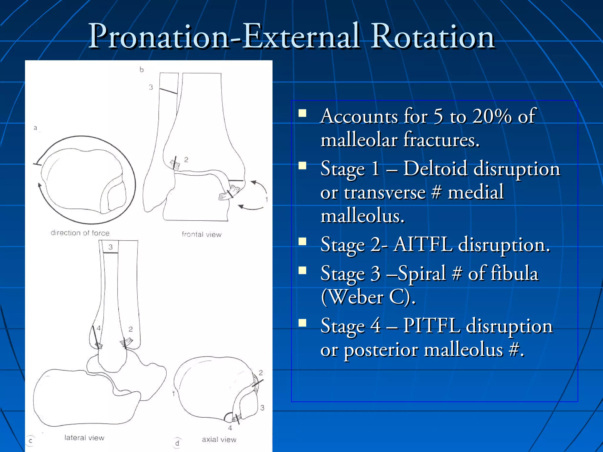 Ankle fractures | PPT