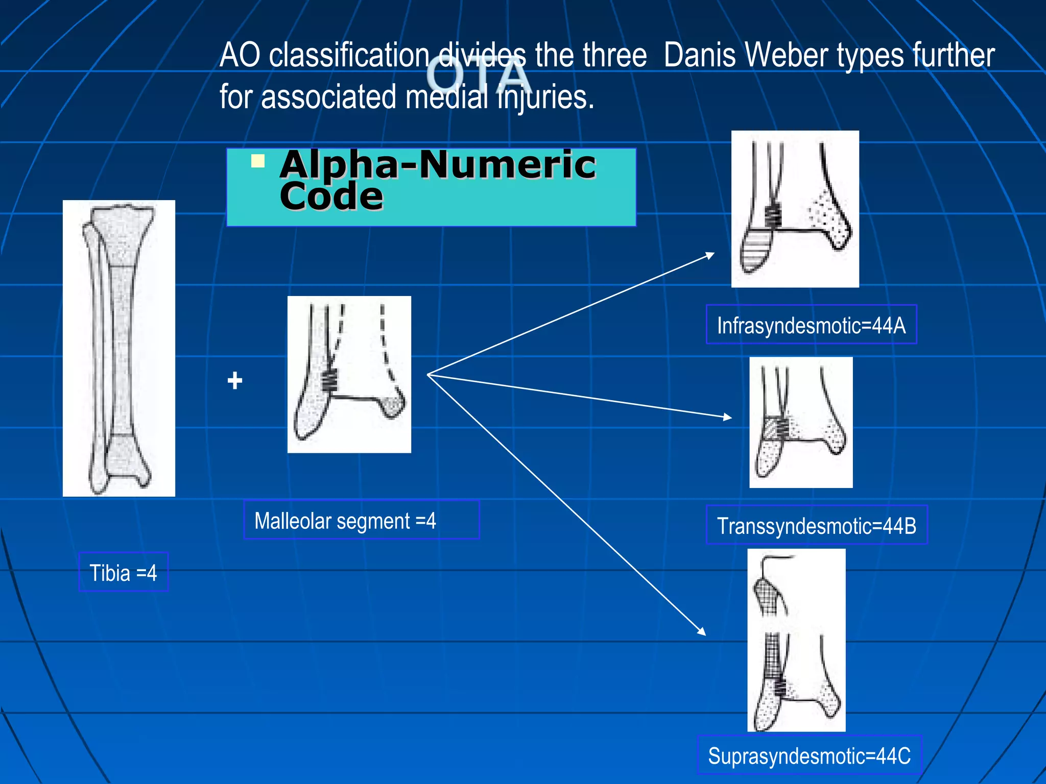 Ankle fractures | PPT