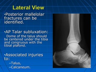 •Posterior mallelolarPosterior mallelolar
fractures can befractures can be
identified.identified.
•AP Talar subluxation:AP Talar subluxation:
Dome of the talus shouldDome of the talus should
be centered under the tibiabe centered under the tibia
and congruous with theand congruous with the
tibial plafond.tibial plafond.
•Associated injuriesAssociated injuries
to:to:
–Talus,Talus,
–Calcaneum.Calcaneum.
 