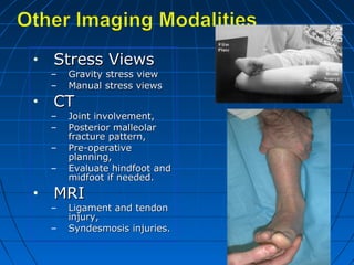 • Stress ViewsStress Views
– Gravity stress viewGravity stress view
– Manual stress viewsManual stress views
• CTCT
– Joint involvement,Joint involvement,
– Posterior malleolarPosterior malleolar
fracture pattern,fracture pattern,
– Pre-operativePre-operative
planning,planning,
– Evaluate hindfoot andEvaluate hindfoot and
midfoot if needed.midfoot if needed.
• MRIMRI
– Ligament and tendonLigament and tendon
injury,injury,
– Syndesmosis injuries.Syndesmosis injuries.
 