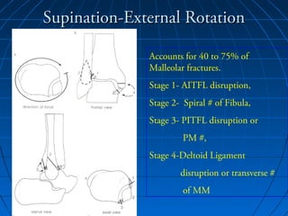 Supination-External RotationSupination-External Rotation
Accounts for 40 to 75% of
Malleolar fractures.
Stage 1- AITFL disruption,
Stage 2- Spiral # of Fibula,
Stage 3- PITFL disruption or
PM #,
Stage 4-Deltoid Ligament
disruption or transverse #
of MM
 