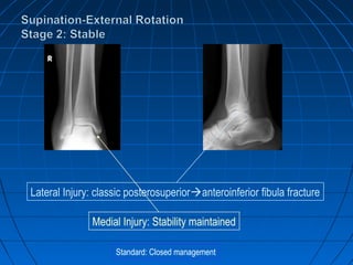 Standard: Closed management
Lateral Injury: classic posterosuperioranteroinferior fibula fracture
Medial Injury: Stability maintained
 