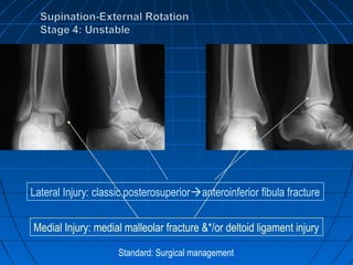 Lateral Injury: classic posterosuperioranteroinferior fibula fracture
Medial Injury: medial malleolar fracture &*/or deltoid ligament injury
Standard: Surgical management
 